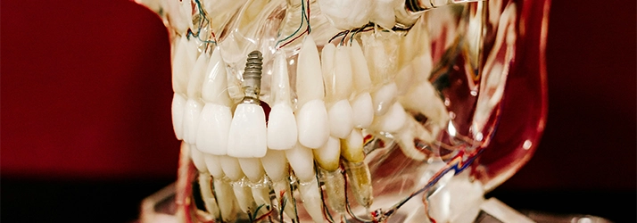 FC – Expert Dental Implant Care at iSmileBrooklyn in Brooklyn NY